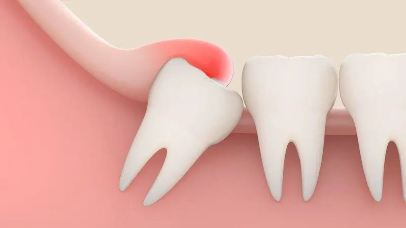 Why Are Wisdom Teeth Needed And Should They Be Removed, Including On The Lower Jaw