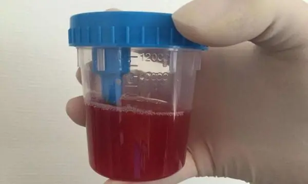 Bloedige urine