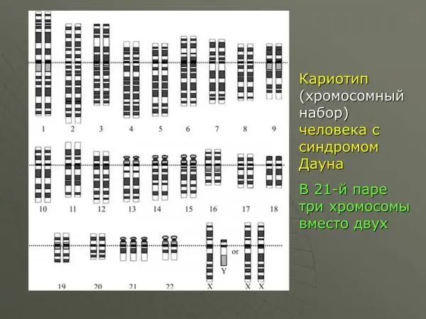 karyotype ของมนุษย์ในกลุ่มอาการดาวน์